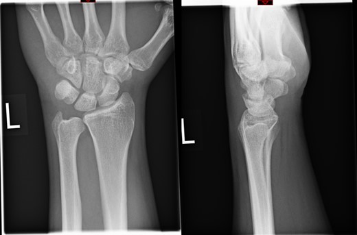 Radiograph at 3 months showing pisiform bone anatomically reduced and maintained.