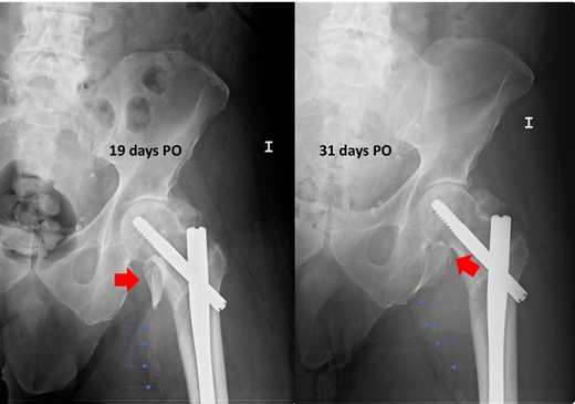 Postoperative radiographs after intertrochanteric fracture synthesis with trochanteric nail 19 and 31 days after surgery. Secondary displacement of LT can be observed (wide arrows) and of the calcified femoral vessels (thin arrows), indirect signs of the presence of a pseudoaneurysm.