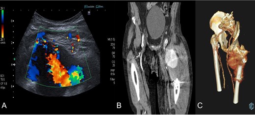 Diagnosis confirmation by Doppler ultrasound (A), shows hypoechoic lesion with turbulent flow inside with 5–6 cm of maximum diameter; and CT angiography (B) and three-dimensional reconstruction (C) that confirm a lateral circumflex artery pseudoaneurym branch of the deep femoral artery of 7,3 × 6,7 × 6 cm size.