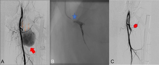 Radioescopic images sequence of the interventional procedure of embolization by retrograde right femoral puncture. A: Lateral femoral circumflex artery (thin arrows) branch of the deep femoral artery, pseudoanerysm (wide arrow). B: Embolization using two Axium 3D distal coils (star). C: Final result with embolized lateral circumflex artery (Cross).