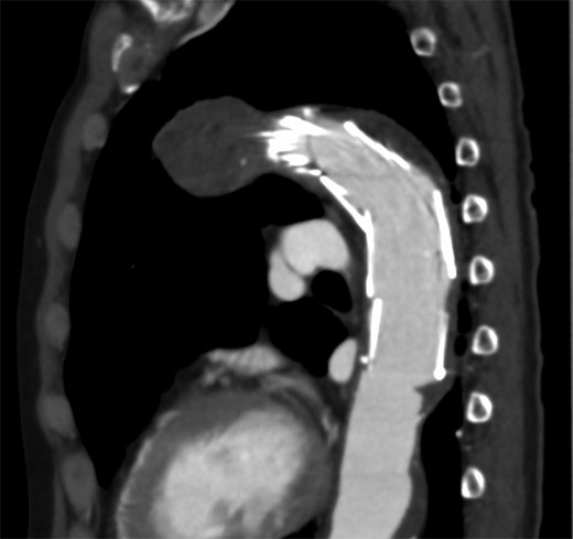 The distal side of the stent graft was placed to stick the thrombus of the aorta.