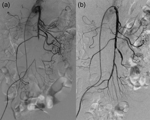(a) pre IVR contrast injection (b) post IVR contrast injection.