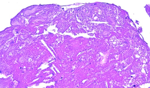 Pathological findings. Cholesterol clefts is observed.