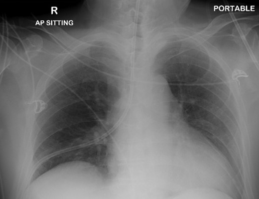 Chest x-ray showing the nasogastric tube, traversing the right main bronchus with the tip in the right costophrenic sulcus.