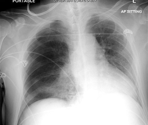 Chest X-ray following removal of the nasogastric tube, with interval development of a right sided pneumothorax.