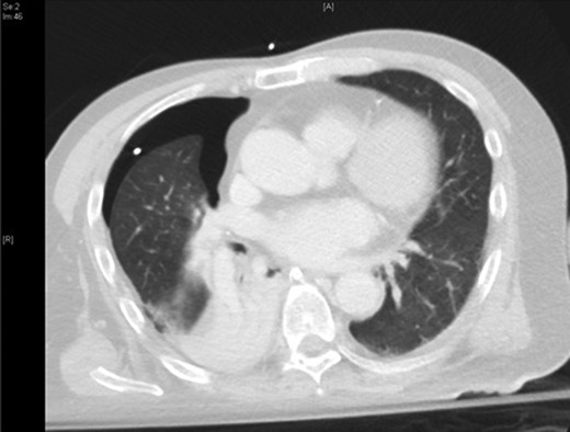 Representative axial slice of computed tomography thorax showing a residual but smaller pneumothorax with the chest tube in situ.