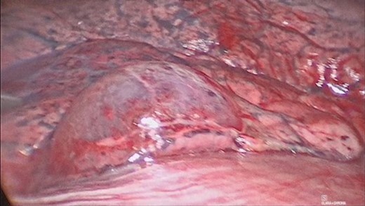 Video assisted thoracoscopic surgery showing an area of right lung associated with a bleb and contusional changes.