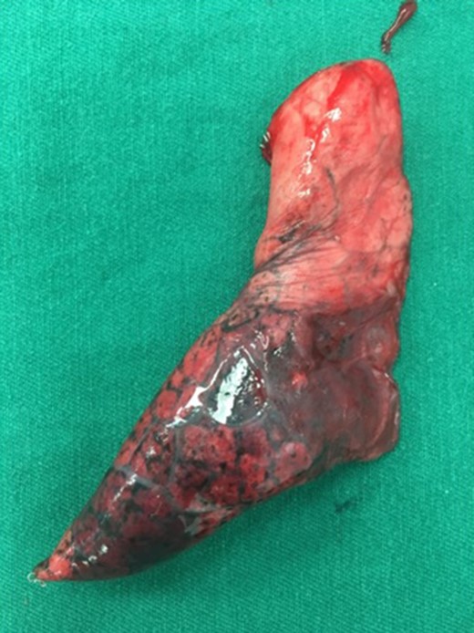 Wedge resection specimen of the lung.