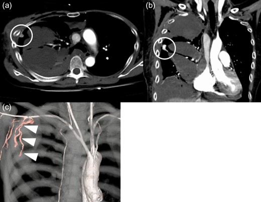Contrast-enhanced computed tomography findings at 1 week. There is a tuberous enhancement in the right chest cavity near the fourth intercostal space (circle). Right lateral thoracic artery (arrow heads) connect to a tuberous enhancement. Axial view (a). Coronal view (b). Three-dimensional volume rendering computed tomography (c).