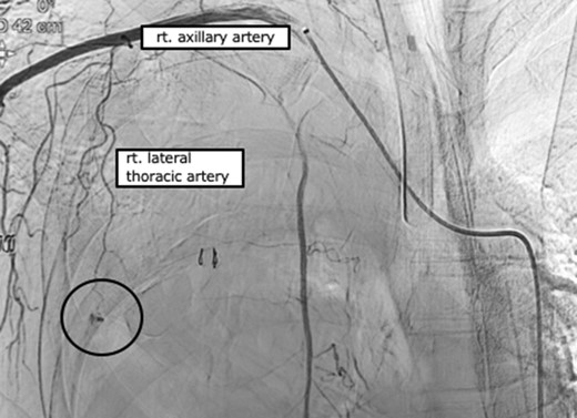 Angiography findings. Extravasation of contrast medium from the right lateral thoracic artery pseudoaneurysm (circle).