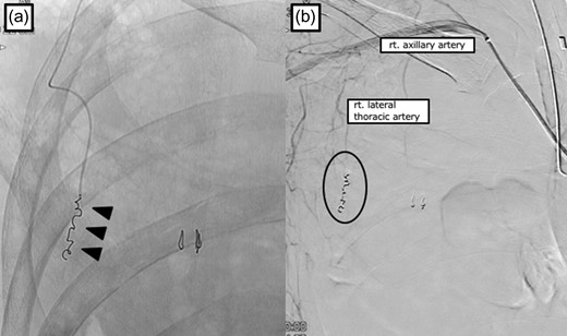 Angiography findings. Coil embolization with gelatin sponge injection for the right lateral artery pseudoaneurysm (arrowhead) (a). Extravasation from the right lateral thoracic artery has disappeared (b).