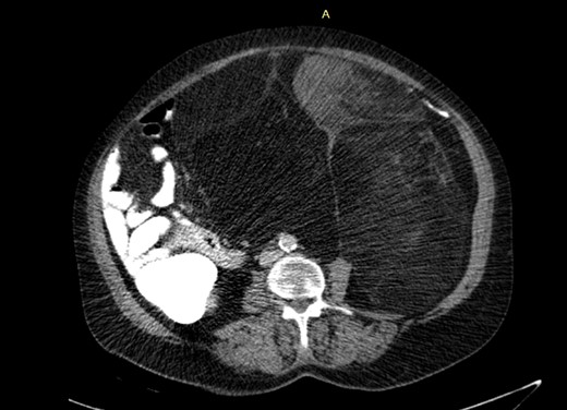 Abdominal CT: The mesenteric fat in the Abdominal cavity is bulky and heterogeneous with soft tissue component anteriorly.