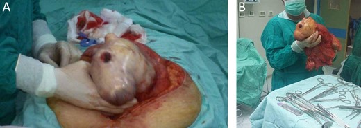 A) laparotomy with midline incision was approached for resection. (B) Gross total resection of the 35×22×17 cm retroperitoneal mass with smooth regular surface and without resection of any adjacent organs.