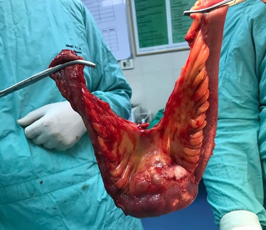 Gross total resection of the mass with 30 cm ileum segment.