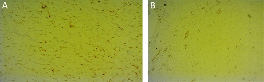 A) Immunohistochemistry: Adipocytic cells exhibit S-100 protein immunoreactivity highlighting the presence of lipoblasts. (B) smooth muscle actin.