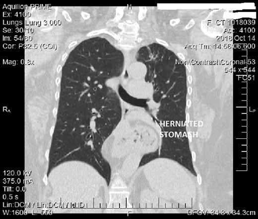 Type 4 Hiatal hernia CT picture.