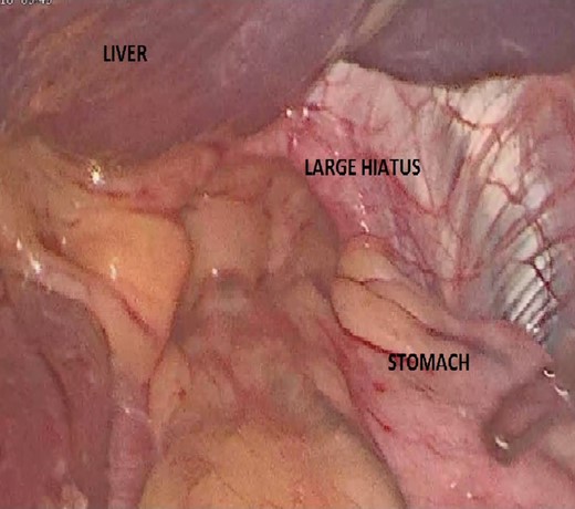 Large hiatus/diaphragmatic hernia.