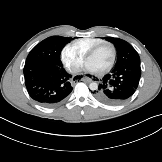 Shows evidence of esophageal rupture and leak with pneumomediastinum and air and fluid surrounding the esophagus.