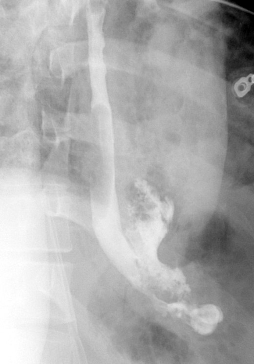 Demonstrates narrow esophageal caliber and extensive distal left thoracic esophageal leak approximately 3 cm proximal to the GE junction.