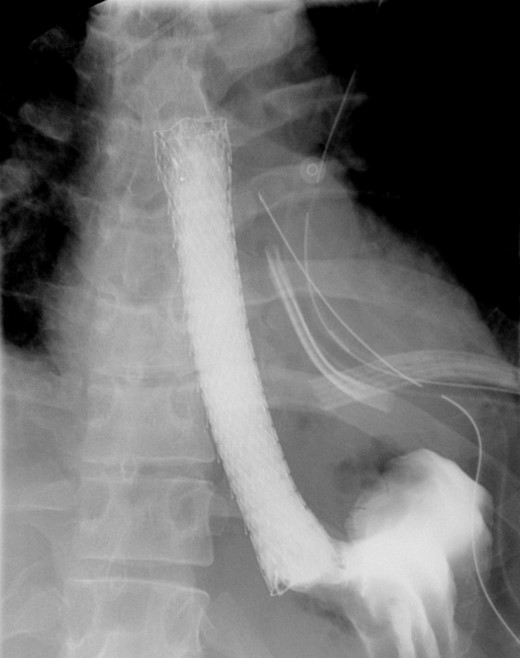 Shows metallic expandable stent in a satisfactory position in the mid to lower thoracic esophagus extending to the GE junction. Water-soluble contrast is seen filling the stent with no evidence of extravasation.