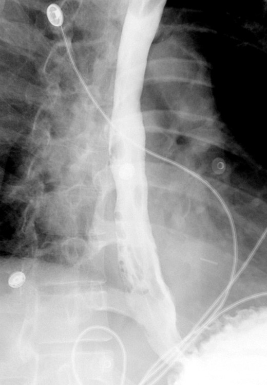 Shows interval removal of the esophageal stent with no evidence of an esophageal leak.