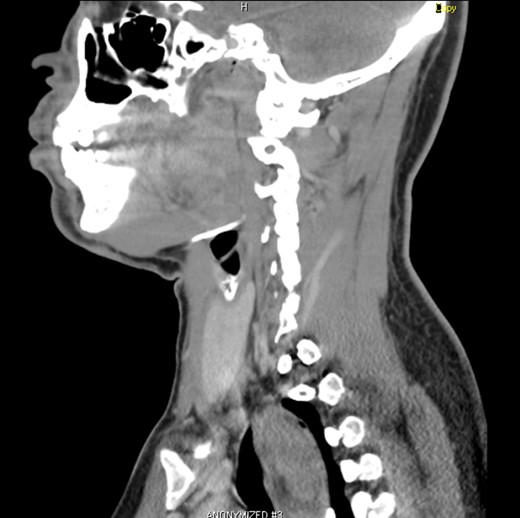 Sagittal CT showing the oesophageal tumour.