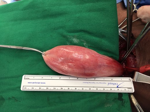 Oesophageal tumour delivered through the incision.