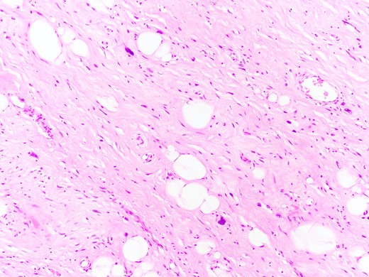 Atypical lipomatous tumour of the oesophagus with the characteristic scattered cells with large hyperchromatic nuclei (H&E, x 400).