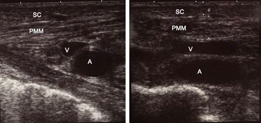Intra-operative ultrasound examination for confirming the position of organs before infusion of tumescent local analgesia solution. The thickness of the subcutaneous tissue, 2.6 mm; and pectoralis major muscle, 5.6 mm. (a) The right side of the picture is the superior (head) side of the patient. (b) The right side of the picture is the right side of the patient. SC, subcutaneous tissue; PMM, pectoralis major muscle; V, axillary vein; A, axillary artery.