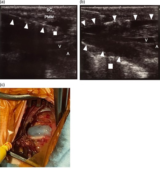 (a) Ultrasound-guided tumescent local analgesia technique. Tumescent local analgesic solution was infused under ultrasound image guidance. The 18-gauge needle can be easily identified (triangle. The tip of the needle is indicated by square.) and solution infusion can be observed. (b) After infusion of the solution. The area under the pectoralis major muscle was dissected and a pocket was made (surrounded by triangle) for placing the pacemaker. The surrounding tissue blood vessels were also dissected. Square indicates the first rib. c. Picture of the operation site after exposure of the axillary vein. Vasoconstriction of the axillary vein did not hinder the placement of the leads using purse string suture and Seldinger technique. The surrounding tissue is edematous because of tumescent local analgesia solution injection. But the we could easily identify the anatomical structures. The bleeding was limited due to the epinephrine in the tumescent local analgesia solution. SC, subcutaneous tissue; PMM, pectoralis major muscle; V, axillary vein; A, axillary artery.