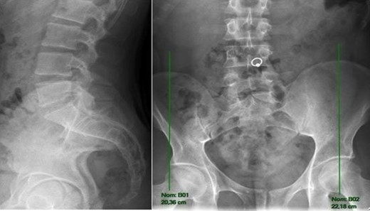 Radiography of lumbar spine in anterior-posterior and lateral views showing asymmetry of pelvis.
