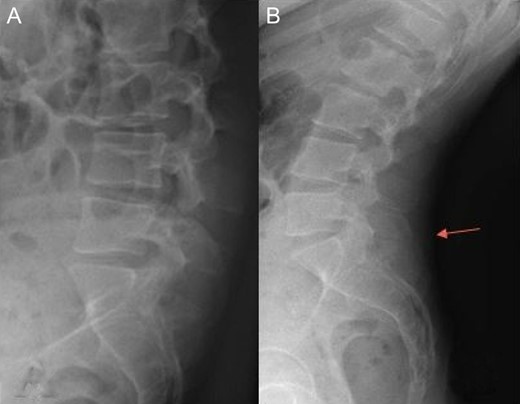 Radiography of lumbar spine (A: flexion, B: extension). We can see a contact between spinous processes of L5 and S1 (arrow).