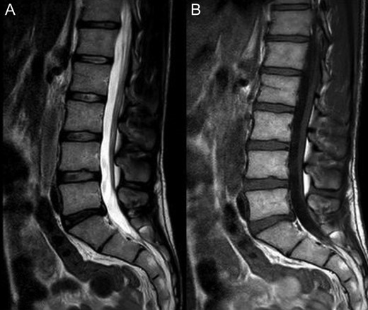A: T2, B: T1; Weighted sagittal Lumbar MRI showing discal hernia L5-S1, small interspinous bursitis L3-L4 and L4-L5, L5-S1 rift + edema, spina bifida occulta (usually asymptomatic).