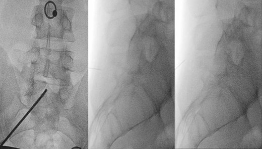 Left: localization of pressure-induced pain. Middle and right: under fluoroscopic guidance, S1 perispinous infiltration.