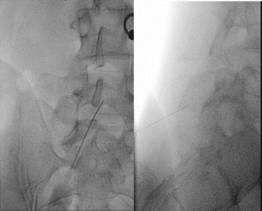 Under scopic control, spinous process block L5-S1.