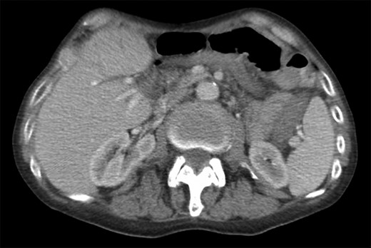 Computed tomography scan of the abdomen and pelvis with intravenous contrast (Omnipaque 350TM, iohexol, 50 mL). No evidence of pancreatic mass or biliary ductal dilation was identified.