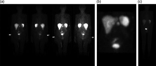 (a–c) (a and b.) Octreotide scan demonstrating increased activity in the peripancreatic region (6.6 mCi of Indium-111 labeled octreotide). (c) Repeat octreotide scan (6 of Indium-111 labeled octreotide) at 4 months post-resection demonstrated normal distribution of activity in the liver, spleen and urinary system. No other focal area of activity was identified.