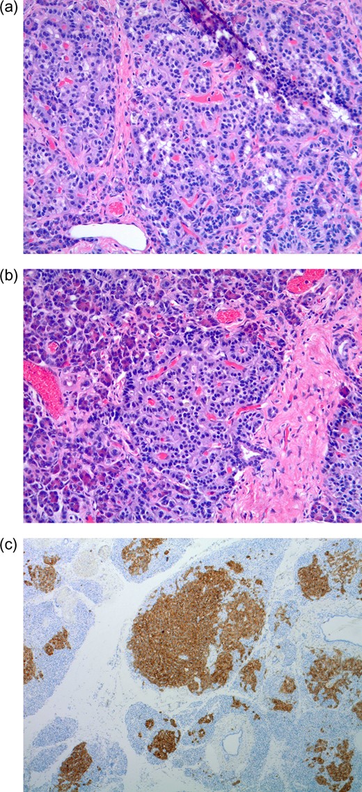 (a–c) Permanent pathology. (a and b) Multiple pancreatic microadenomas scattered throughout the pancreatic head parenchyma. (c) Immunohistochemical stains positive for synaptophysin.