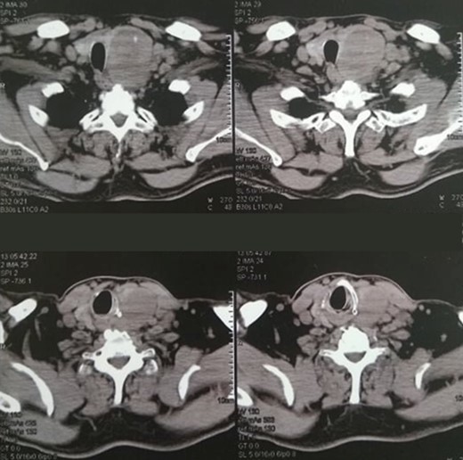 Cervical CT scan, showing a 7-cm node of the left thyroid lobe and concommitent multiple left cervical nodal enlargement.
