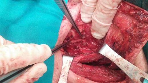 Lymphadenectomy of the left cervical compartments.