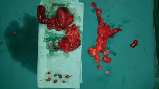 Total thyroidectomy and extended cervical lymphadenectomy. Excised specimen.
