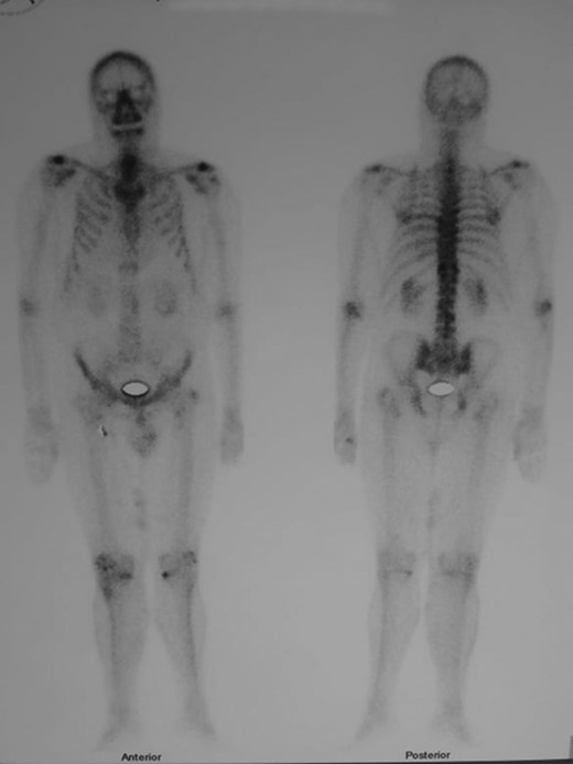 Total body SPECT scan performed after adjuvant radioiodine treatment. No abnormal distribution is observed.