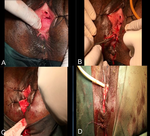(A) VVF with perineal body (almost inexistent) laceration; (B) Perineal body excision; (C) Rectal exam on anal sphincter; (D) Closed VVF, restructured anal sphincter and perineal body.