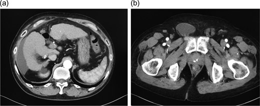 a) Abdominal contrast-enhanced computed tomography shows moderate ascites in the abdominal cavity. (b) Abdominal contrast-enhanced computed tomography shows an indirect hernia in the right inguinal area, with inflow of ascites into the hernia sac.