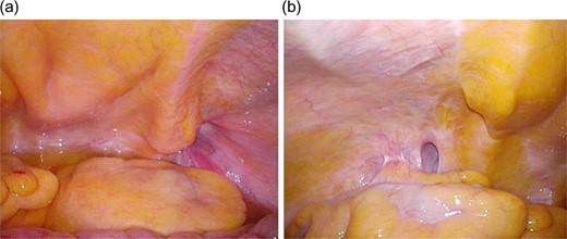(a) On intraoperative laparoscopic view, right-sided indirect inguinal hernia and ascites in the pouch of Douglas are seen. (b) On intraoperative laparoscopic view, left-sided indirect inguinal hernia is seen.