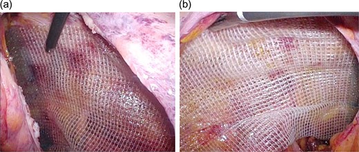 (a) After peritoneal dissection, a self-fixating mesh (ProGripTM; 15 × 10 cm2) was placed. Intraoperative laparoscopic view (right inguinal hernia). (b) After peritoneal dissection, a self-fixating mesh (ProGripTM; 13 × 9 cm2) was placed. Intraoperative laparoscopic view (left inguinal hernia).