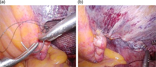 a) Peritoneal closure was performed using uninterrupted barbed sutures (V-LocTM). Intraoperative laparoscopic view. (b) Intraoperative laparoscopic view following completion of peritoneal closure.