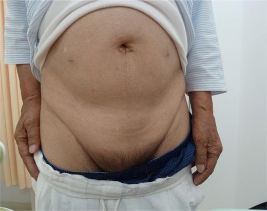 At the first examination following discharge, a mild seroma can be seen in the right inguinal area. However, there are no signs of recurrence or infection.