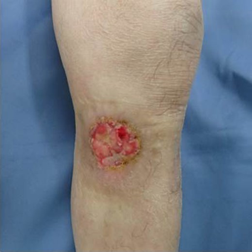 Frontal view of the tumor.