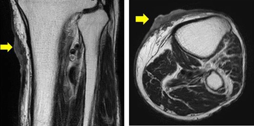 Horizontal and sagittal views on MRI T2 (yellow arrow indicates the tumor).